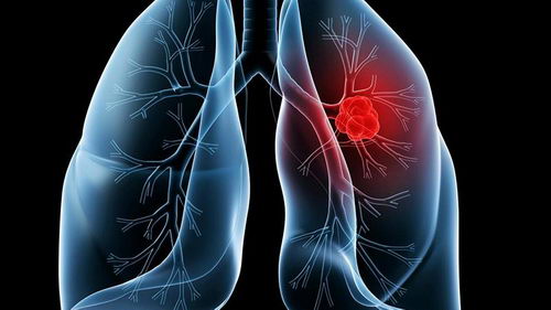 易瑞沙和泰瑞沙区别，奥希替尼azd9291相对于易瑞沙，特罗凯治疗肺癌的优势在哪里？