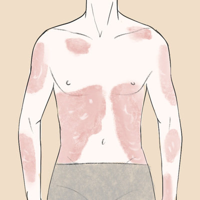 招募中重度斑块状银屑病患者 | 神州细胞SCT650C注射液体