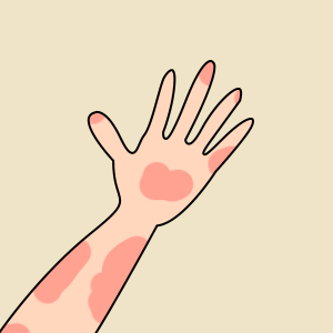 招募中重度特应性皮炎患者 | IBI356（OX40L注射液）