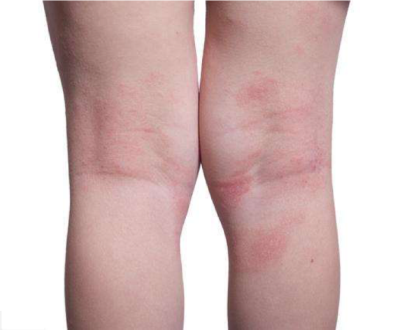 特应性皮炎日常护理注意事项有哪些? - 伊顿健康